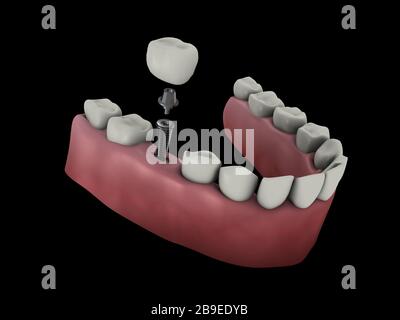 Illustration médicale d'un implant dentaire. Banque D'Images