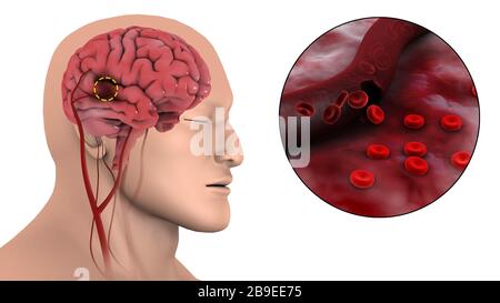 Illustration médicale d'un AVC hémorragique dans le cerveau. Banque D'Images