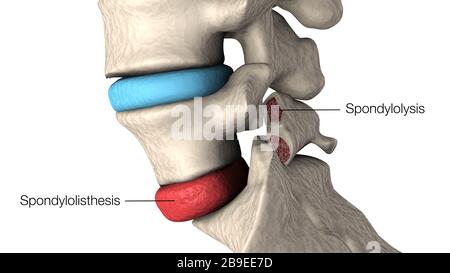 Illustration mettant en évidence la spondylolisthrite et la spondylolyse dans les vertèbres humaines. Banque D'Images