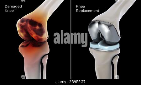 Illustration médicale montrant le remplacement du genou d'un genou endommagé. Banque D'Images
