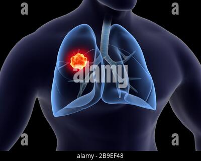 Illustration médicale du cancer du poumon à l'intérieur des poumons humains. Banque D'Images