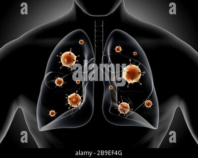 Illustration médicale montrant la pneumonie dans les poumons humains. Banque D'Images