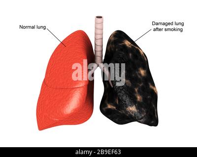 Comparaison d'un poumon sain par rapport au poumon d'un fumeur. Banque D'Images