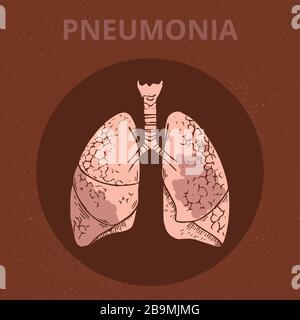 Une illustration schématique du corps humain avec une infographie des symptômes du covid du coronavirus 19. Illustration de Vecteur