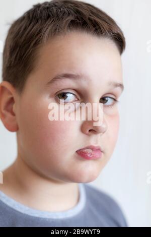 un garçon malade avec de grandes chasues sur ses lèvres Banque D'Images