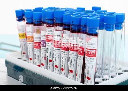Plusieurs échantillons de sang fictif infectés avec divers virus sur un portoir de flacons. Banque D'Images