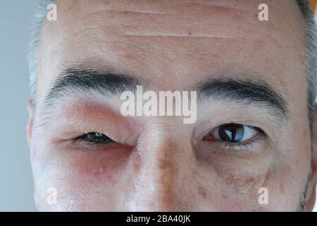 Visage de l'homme d'âge moyen avec oeil gonflé de la piqûre de la guêpe, nécrose visible autour du site d'injection, gros plan Banque D'Images