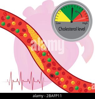 Plaque athérosclérotique dans le vaisseau sanguin, bons et mauvais lipides Illustration de Vecteur