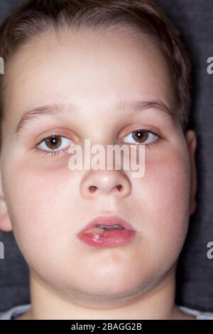 un garçon malade avec de grandes chasues sur ses lèvres Banque D'Images