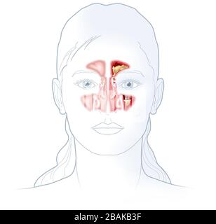 Illustration montrant un sinus sain et une sinusite avec une doublure enflammée, une ouverture de sinus obstruée, un énoïde et un excès de mucus Banque D'Images
