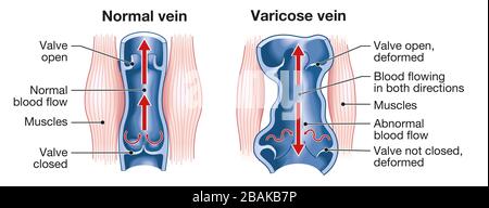 Illustration montrant les varices et les veines normales Banque D'Images