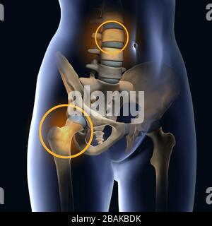 Femme souffrant d'ostéoporose, accent coloré sur l'articulation de la hanche et le corps vertébral, illustration médicale Banque D'Images