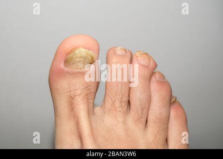 Jeune gars pieds nus doigts avec des ongles d'onycho malade mycosis, dermatologique médicale Banque D'Images