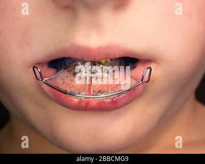 Adolescent portant des étrésillons orthodontiques et montrant la langue. Dents avec supports orthodontiques. Soins de santé dentaires. Banque D'Images