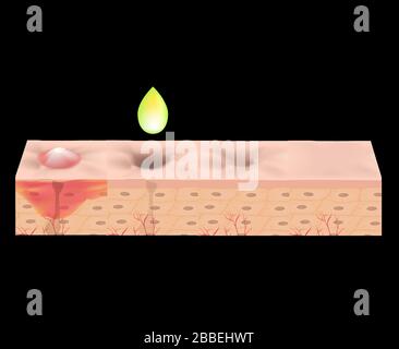 Cicatrices atrophiques. Cicatrice d'acné. La structure anatomique de la peau avec l'acné. Illustration vectorielle. Illustration de Vecteur