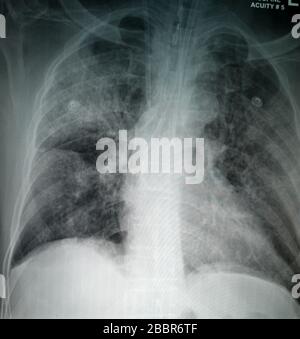 Radiographie thoracique d'un patient soupçonné du virus Corona image de haute qualité montrant des changements dans les poumons dus au virus Covid-19 avec tube thoracique Banque D'Images