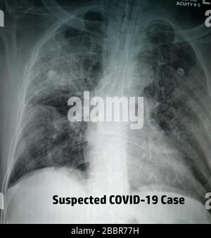 Radiographie thoracique de la patiente suspectée de virus Corona image de haute qualité montrant des changements dans le poumon en raison du virus Covid-19 avec des tubes de poitrine Banque D'Images