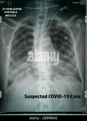 Radiographie thoracique de la patiente suspectée de virus Corona image de haute qualité montrant des changements dans le poumon en raison du virus Covid-19 avec des tubes de poitrine Banque D'Images