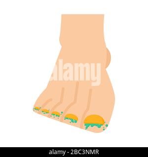 Champignon sur les jambes. Maladie des ongles. Infection des orteils. Illustration vectorielle Illustration de Vecteur