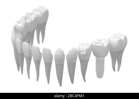 Implant dentaire/implant dentaire Banque D'Images
