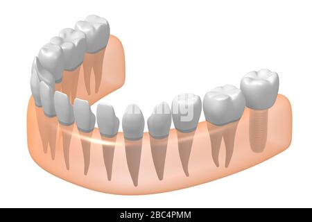 Implant dentaire/implant dentaire Banque D'Images