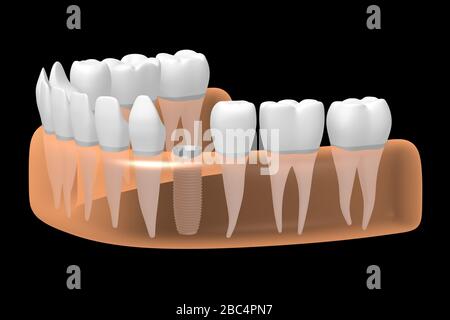 Implant dentaire/implant dentaire Banque D'Images