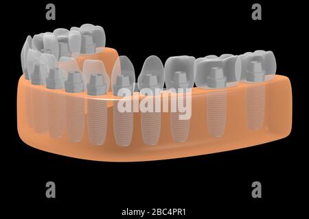 Implants dentaires/implants dentaires Banque D'Images