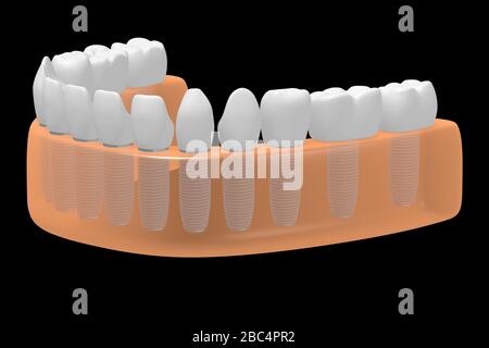 Implants dentaires/implants dentaires Banque D'Images