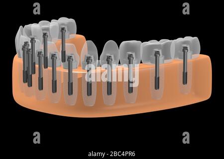 Implants dentaires/implants dentaires Banque D'Images