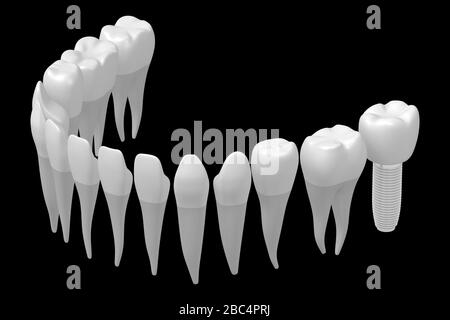 Implant dentaire/implant dentaire Banque D'Images