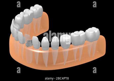 Implant dentaire/implant dentaire Banque D'Images