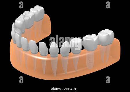 Implant dentaire/implant dentaire Banque D'Images
