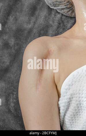 Cicatrice keloïde verticale après chirurgie osseuse sur l'épaule de la femme Banque D'Images