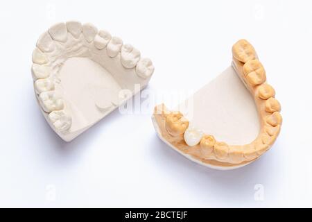 sur un fond blanc sont des modèles de plâtre des mâchoires avec une couronne en céramique faite sur un molaire. dent artificielle blanche sur l'implant. concept d'orthopédi Banque D'Images