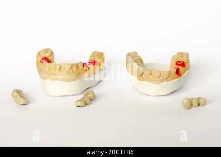 concept de dentisterie orthopédique. prothèses dentaires avec couronnes et ponts en céramique. ponts dentaires sur les dents postérieures. prothèses esthétiques. gyp Banque D'Images