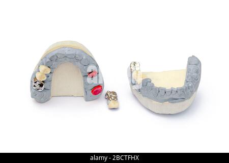 dents artificielles en métal et céramique. concept de remplacement des dents manquantes. prothèses dentaires. isolées Banque D'Images