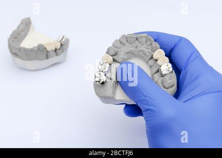 fausses dents. couronnes et ponts en métal et céramique. la main du dentiste est un modèle en plâtre. concept de dentisterie orthopédique Banque D'Images