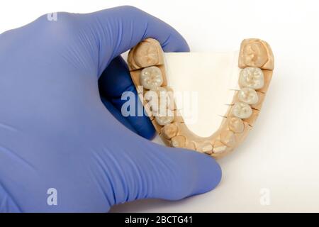 ponts en céramique-métal sur un modèle en plâtre entre les mains d'un dentiste. couronnes en céramique, ponts, implants Banque D'Images