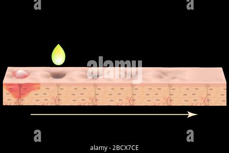 Cicatrices atrophiques. Cicatrice d'acné. La structure anatomique de la peau avec l'acné. Illustration vectorielle. Illustration de Vecteur
