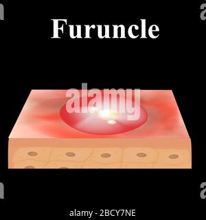 Acné de kyste. furoncle acné sur la peau kystes et boutons. Maladies inflammatoires dermatologiques et cosmétiques sur la peau du visage. Infographies Illustration de Vecteur