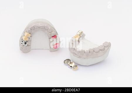 Couronnes dentaires isolées sur fond blanc. Antécédents en dentisterie orthopédique. Ponts et couronnes dentaires en céramique-métal Banque D'Images