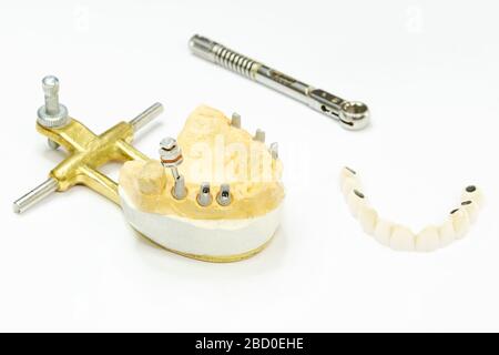 le processus de fabrication des dents en céramique sur les implants. implants dentaires avec dents en céramique sur fond clair. concept d'implantation dentaire et d Banque D'Images