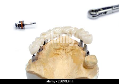 le processus de fabrication des dents en céramique sur les implants. implants dentaires avec dents en céramique sur fond clair. concept d'implantation dentaire et d Banque D'Images
