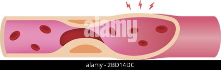 Artère obstruée par une illustration de caillot sanguin Illustration de Vecteur