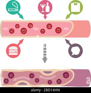 Illustration que le sang sain devient du sang boueux en raison de divers facteurs malsains, causant l'artériosclérose Illustration de Vecteur