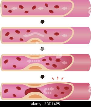 Progression de l'illustration de l'artériosclérose Illustration de Vecteur