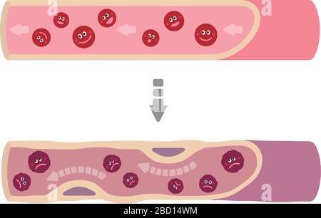 Illustration que le sang sain devient du sang boueux en raison de divers facteurs malsains, causant l'artériosclérose Illustration de Vecteur