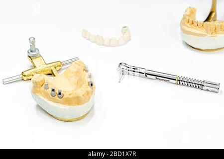 le processus de fabrication des dents en céramique sur les implants. implants dentaires avec dents en céramique sur fond clair. concept d'implantation dentaire et d Banque D'Images