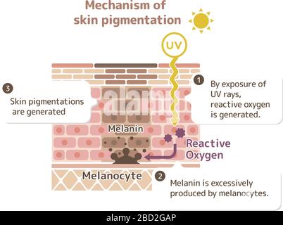 mécanisme de pigmentation de la peau / illustration de tache de peau Illustration de Vecteur