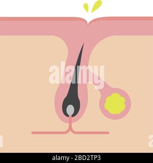 Section transversale des pores ( progression de l'acné) / sécrétion excessive de sébum Illustration de Vecteur